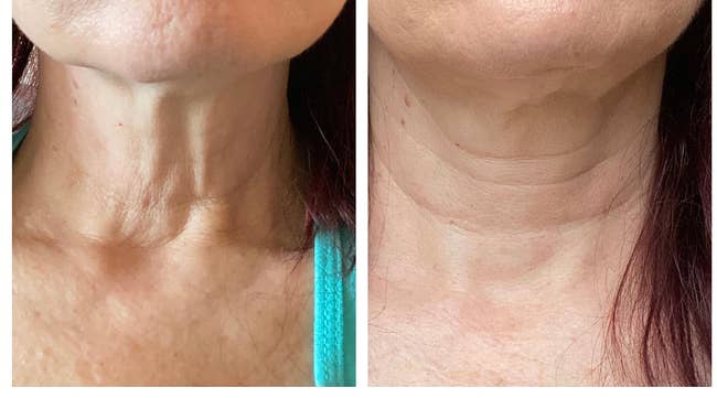 before photo of a reviewer's neck skin looking loose next to an after photo of the same reviewer and their neck skin looks tighter