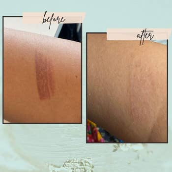 a before photo of a user's skin with a dark mark, and an after photo of the same area with the dark spot diminished  