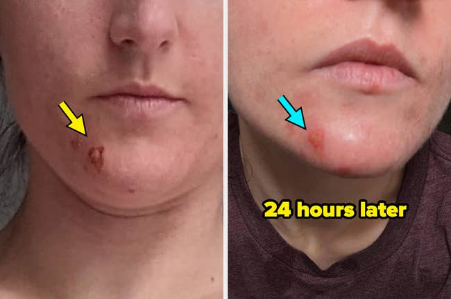 the reviewer using the cream to reduce a pimp and its redness within 24 hours