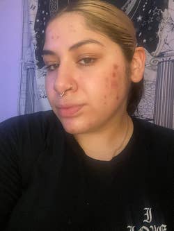 different reviewer showing acne 