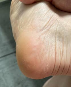 Reviewer's foot after using pumice sponge