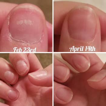a before and after photo of a reviewer showing how much healthier their nails look after two months of using the solution