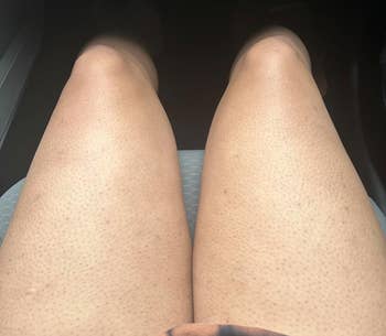 Person's legs with noticeable KP