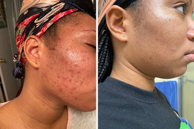 reviewer's before and after showing red, acne covered skin and a follow-up with skin that is less red and completely clear