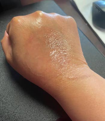 reviewers hand with eczema healed after using the soap