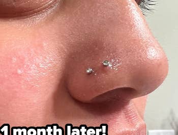  photo of same piercing 1 month after using solution with bump significantly reduced and almost completely gone