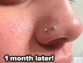 photo of same piercing 1 month after using solution with bump significantly reduced and almost completely gone