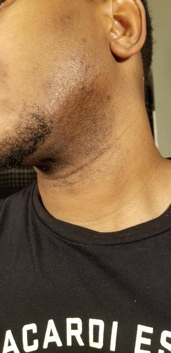 Close-up of aforesaid  person's jawline and cervix  showing betterment  successful  tegument  texture aft  treatment.