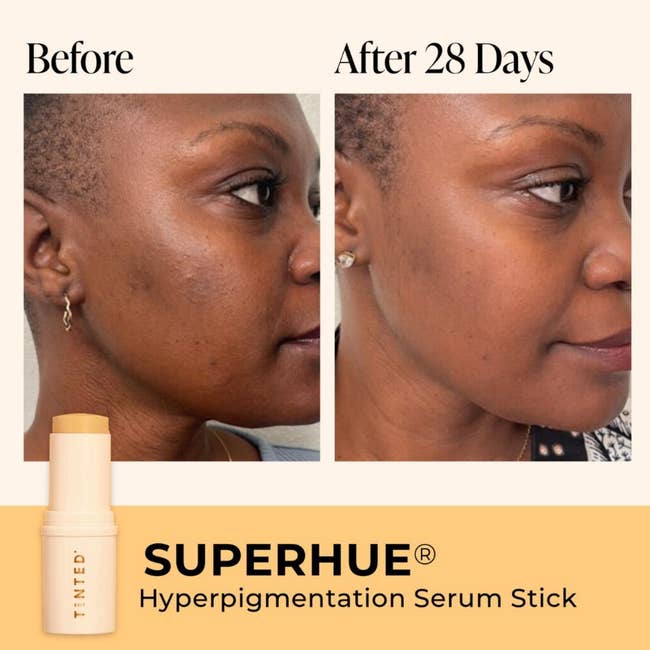 Split image of a person's face before and after using SuperHue Serum, showing skin improvement. 