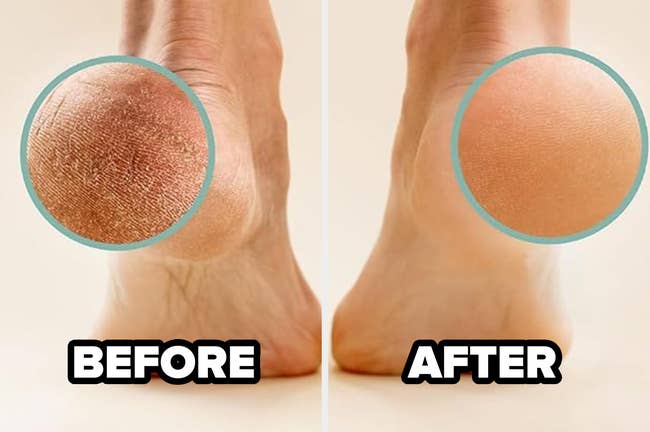 Before and after images show a heel's transformation, highlighting smoother skin treatment results