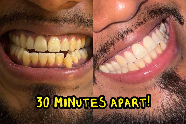 Close-up of a person's teeth earlier and aft whitening, with a substance overlay saying