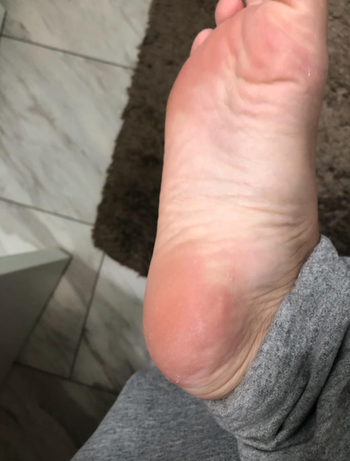 same reviewer's foot without the calluses