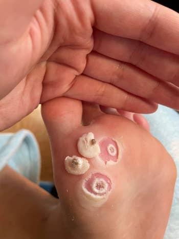 Close-up of a person's foot showing multiple plantar warts. The warts are circular, raised, and bumpy