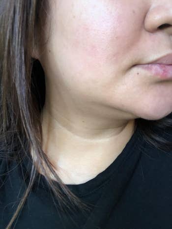same reviewer's after photo showing that the scarring and redness have disappeared