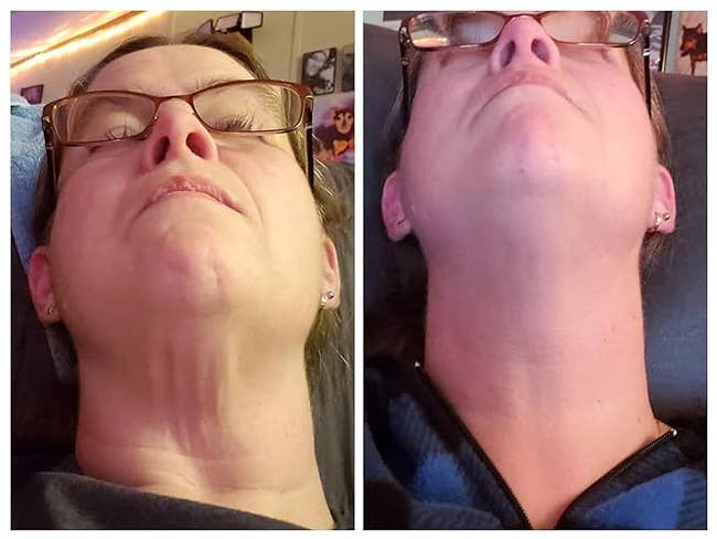 Before and aft images of a person's neck, highlighting changes successful tegument appearance