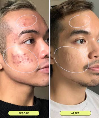 Side-by-side comparison of a person's skin before and after treatment, showing clear improvement
