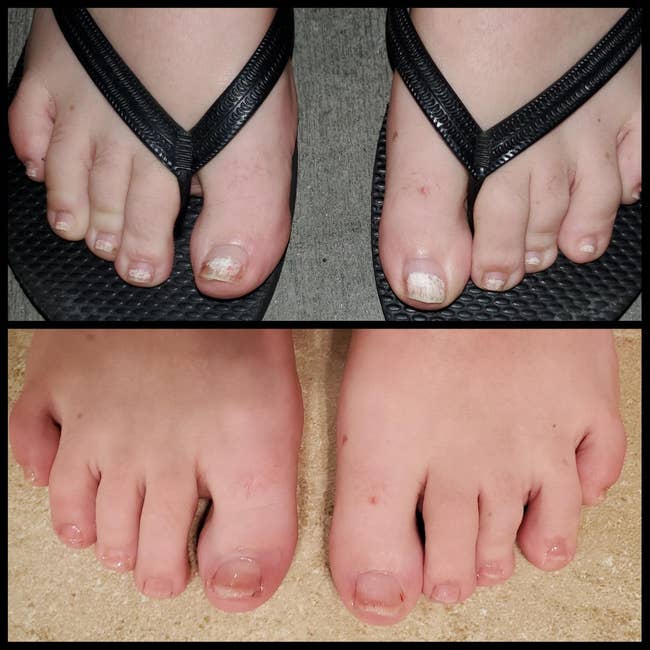 before and after images of a reviewer's toenails with fungus then being removed