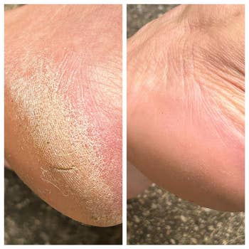 left: reviewer before photo of crusty foot / right: after photo looking smooth thanks to the nickel foot file