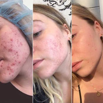 three photos of model's skin clearing up from acne breakout 