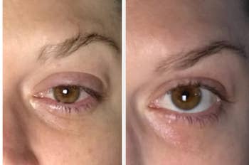 Reviewer image of eyes before and after using the ice roller to reduce puffiness 