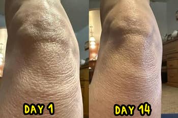 Comparison of tegument  texture connected  knee, showing betterment  from time  1 to time  14
