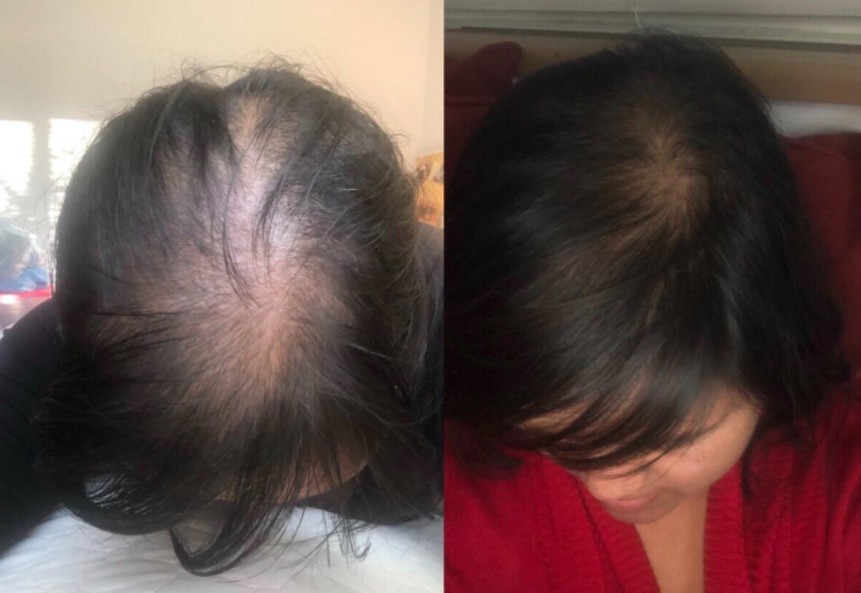 reviewer with lots of hair loss on top of scalp, then same reviewer with hair grown back in from using the shampoo