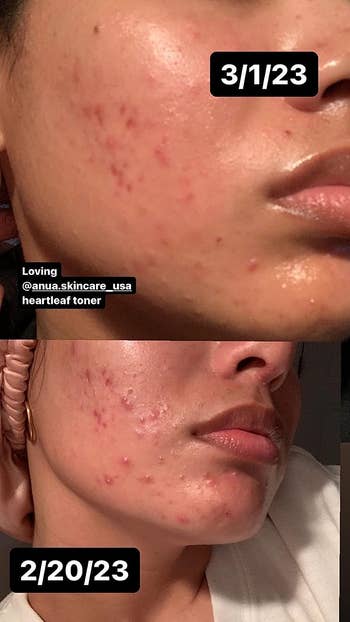 before image of a reviewer with red skin and acne and an after image with severely less redness and acne