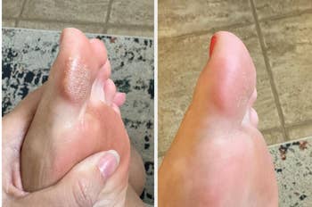 Before and aft  ft  attraction   examination  showing betterment  successful  tegument  texture connected  a toe
