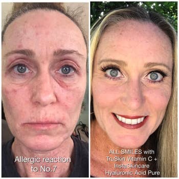 before photo of a reviewer with  redness and dark under-eye circles next to an after photo of the same reviewer whose skin looks glowy, tighter, and radiant after using the vitamin c serum