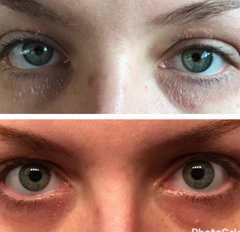Reviewer with dry, scaly skin around their eyes in top photo, and in bottom photo with markedly more hydrated skin and scales gone after using Vanicream