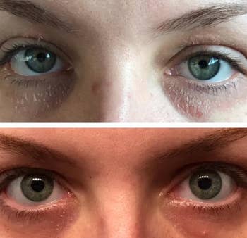 Reviewer with dry, scaly skin around their eyes in top photo, and in bottom photo with markedly more hydrated skin and scales gone after using Vanicream