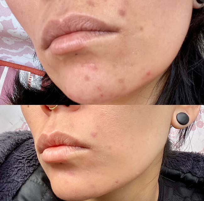 Before and after of a reviewer's skin showing the acne and redness much clearer after using the gel