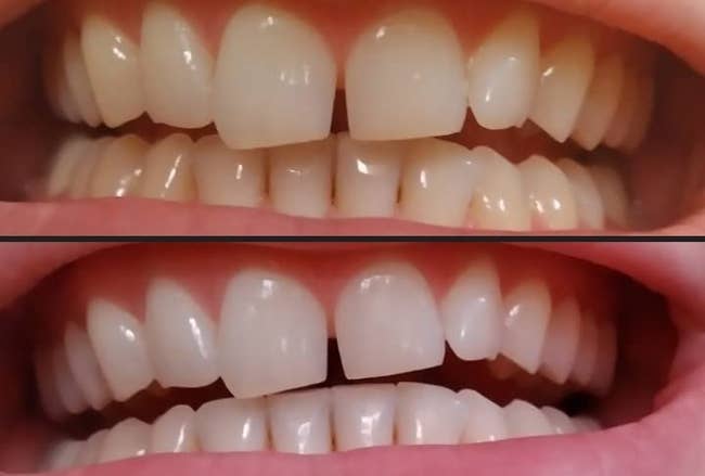 Before and after comparison of teeth whitening treatment