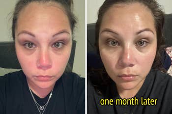 Side-by-side examination  of a woman's look   showing earlier  and aft  skincare results, labeled 