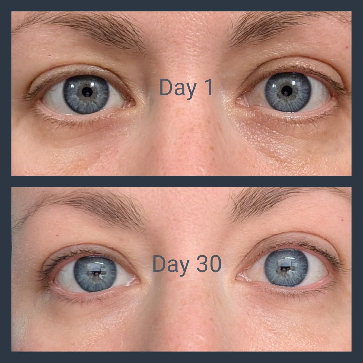 Close-up examination  of a reviewer's eyes, Day 1 shows wrinkles and acheronian  circles, Day 30 appears smoother and brighter