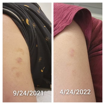 a reviewer's before and after showing improvement on a scar after using bio-oil for 7 months