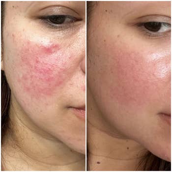 Reviewer before uses cleanser with rosacea glare up and reviewer after using cleanser with cleared skin