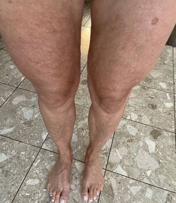 after photo of the same reviewer showing their leg skin is much tighter and the cellulite is basically gone