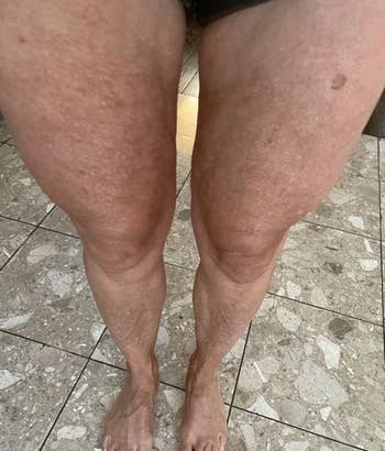 after photo of the same reviewer showing their leg skin is much tighter and the cellulite is basically gone