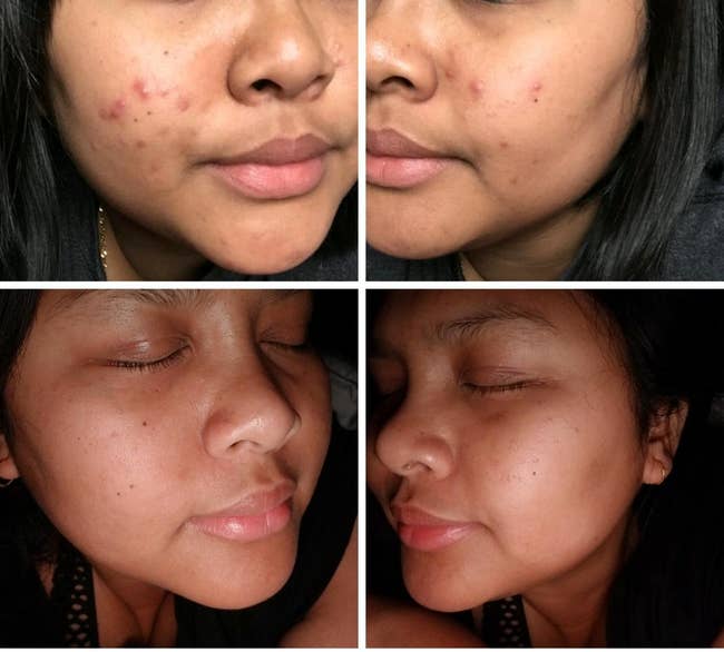 Close-up of a person's face before and after skin treatment, showing improved complexion
