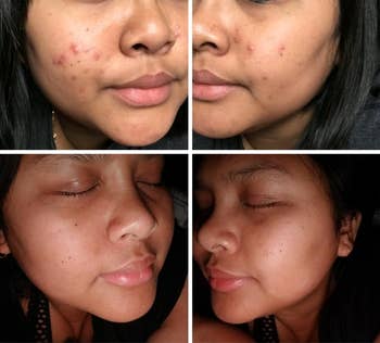 Close-up of a person's face before and after skin treatment, showing improved complexion