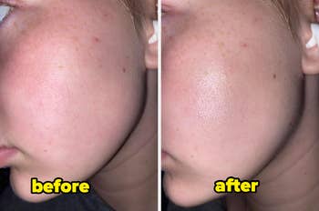 Side-by-side before and after images showing skin texture improvement on a person's cheek. The left image is labeled