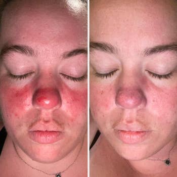 Close-up of a person's look   showing a examination  of tegument  condition; near  broadside  inflamed, close    broadside  calmer