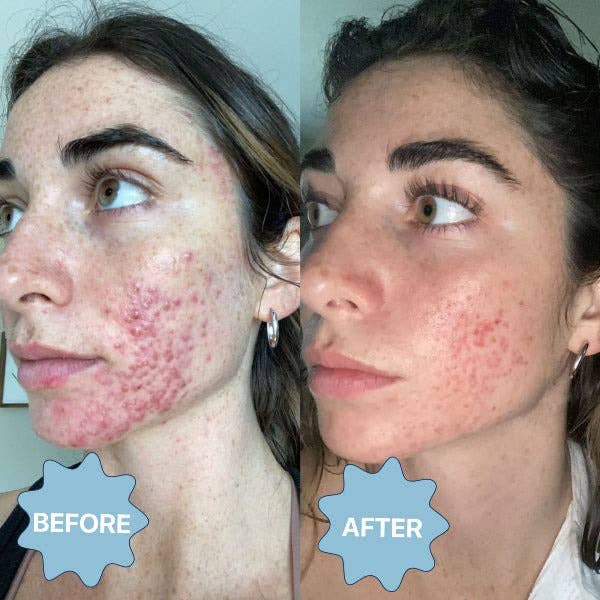 Side-by-side comparison of a person's facial skin condition before and after treatment, with less acne after