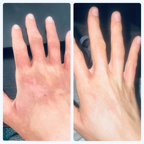 side by side before and after reviewer images of a hand with scarring that disappears
