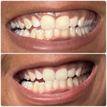  the apical  shows a somewhat  uneven alignment, the bottommost  shows improved straightness