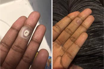 another reviewer's close-up images of fingers showing the earlier  (with a raised wart) and aft  (reduced wart) effects of utilizing a removal treatment