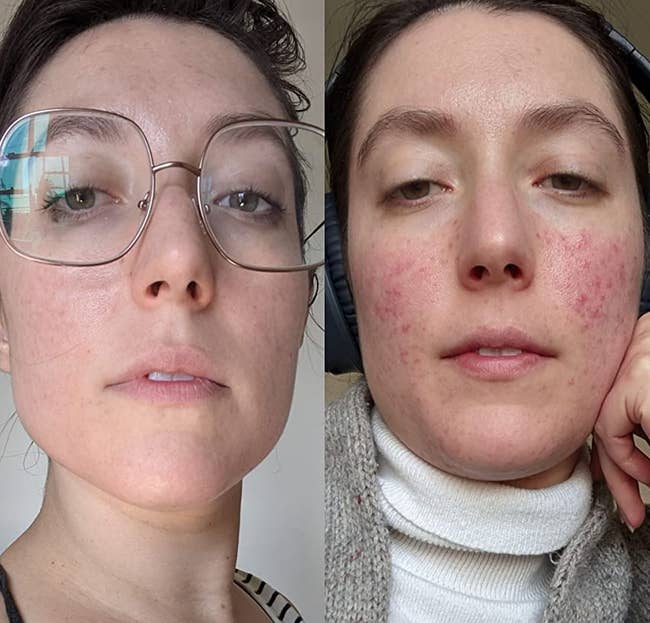 on left: reviewer with clear complexion after using the moisturizing cream. on right, same reviewer with acne on cheeks before using the moisturizing cream