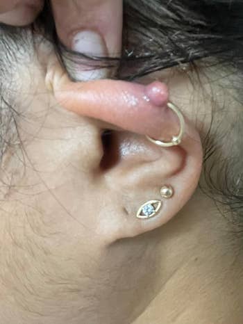 reviewer before photo of cartilage ear piecing with inflamed keloid bump