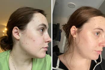 a reviewer before with pimples on their cheek and after with them cleared up